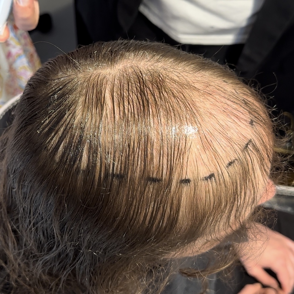 Vorher – Frau vor dem Haarsystem