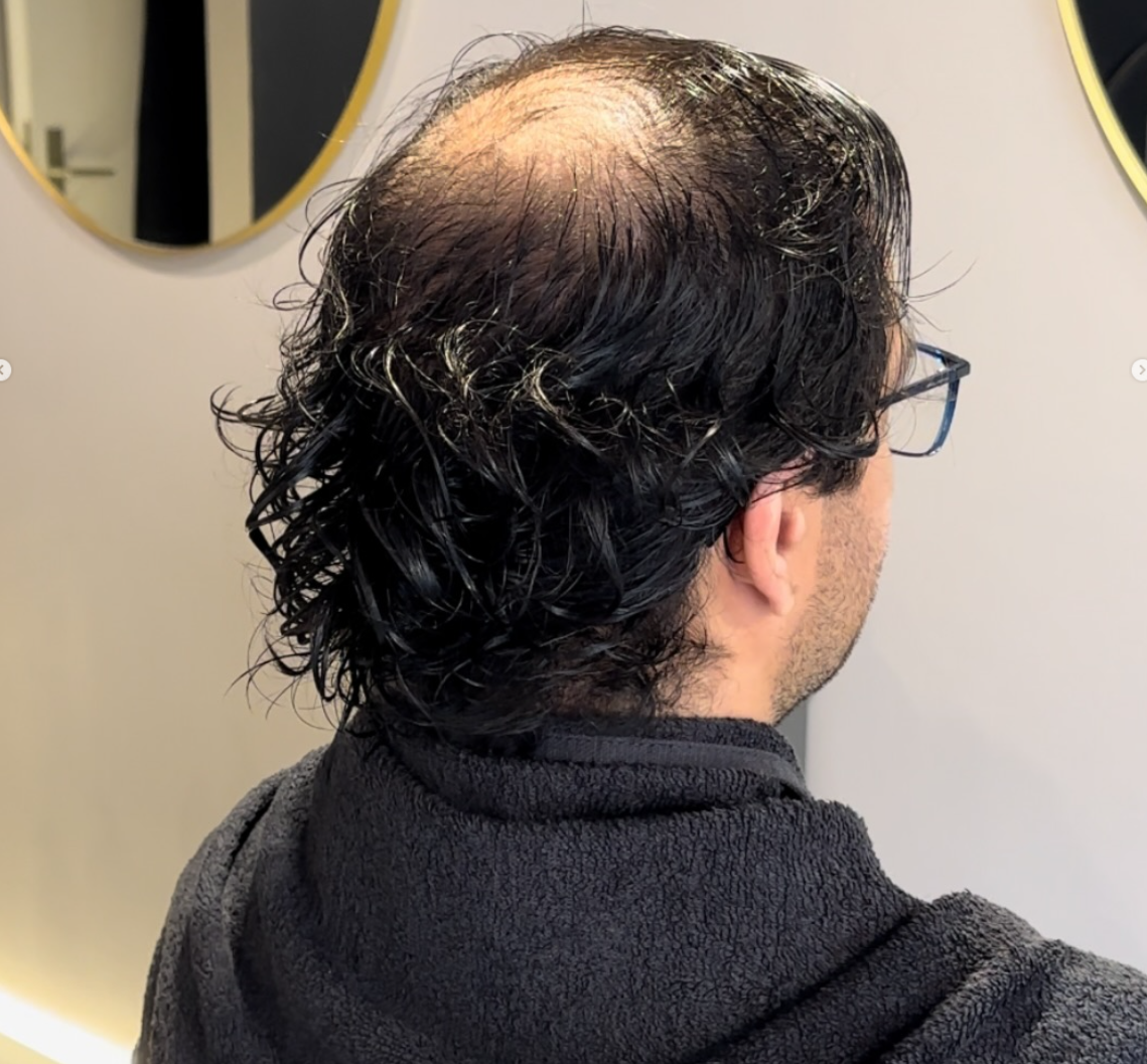 Vorher – Mann mit lichtem Haar