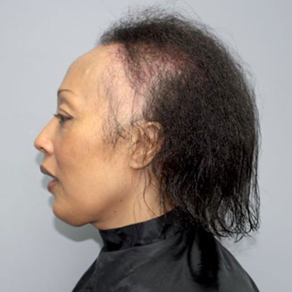 Vorher – Frau mit lichten Stellen