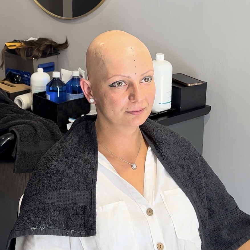 Vorher – Frau mit Haarverlust
