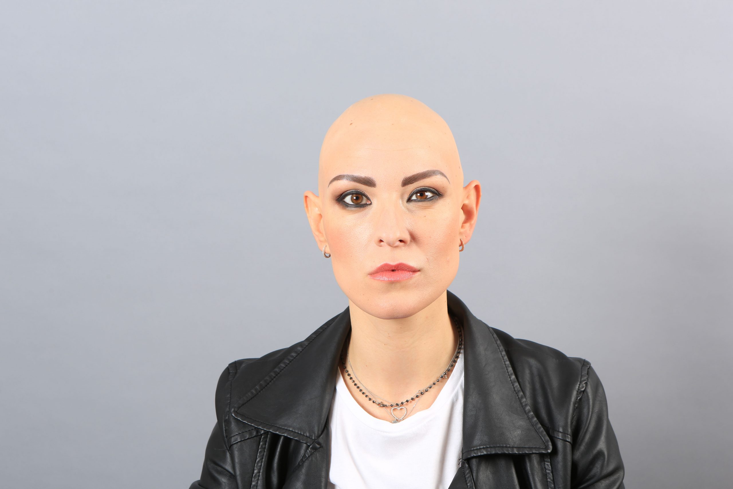 Vorher – Frau mit Glatze