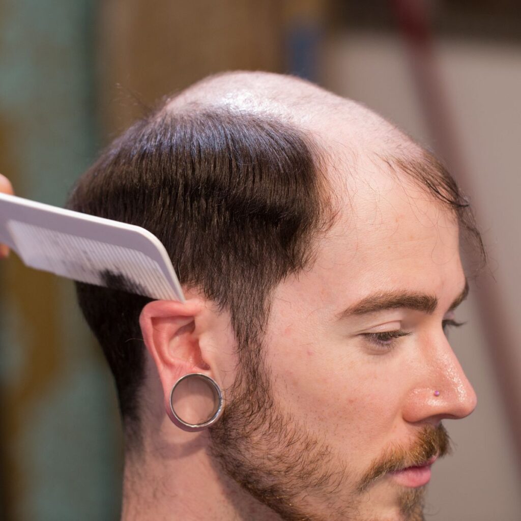 Vorher – Mann mit Haarausfall am Oberkopf